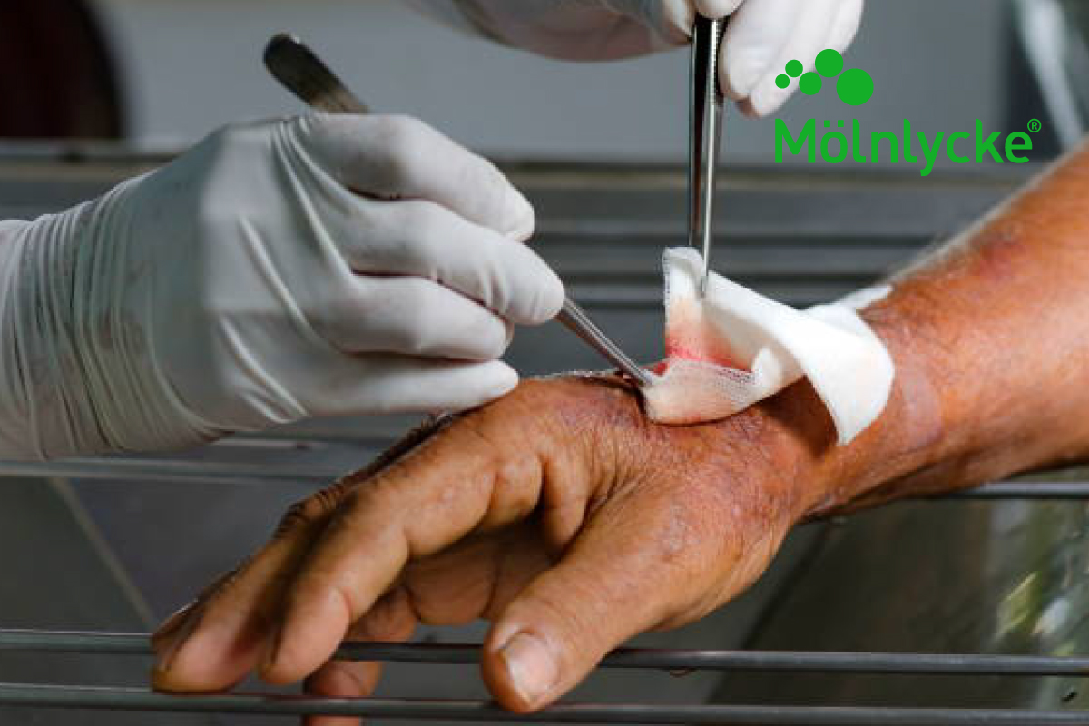 Limpieza y desbridamiento de herida y uso de apósitos para heridas infectadas con tecnología de vanguardia