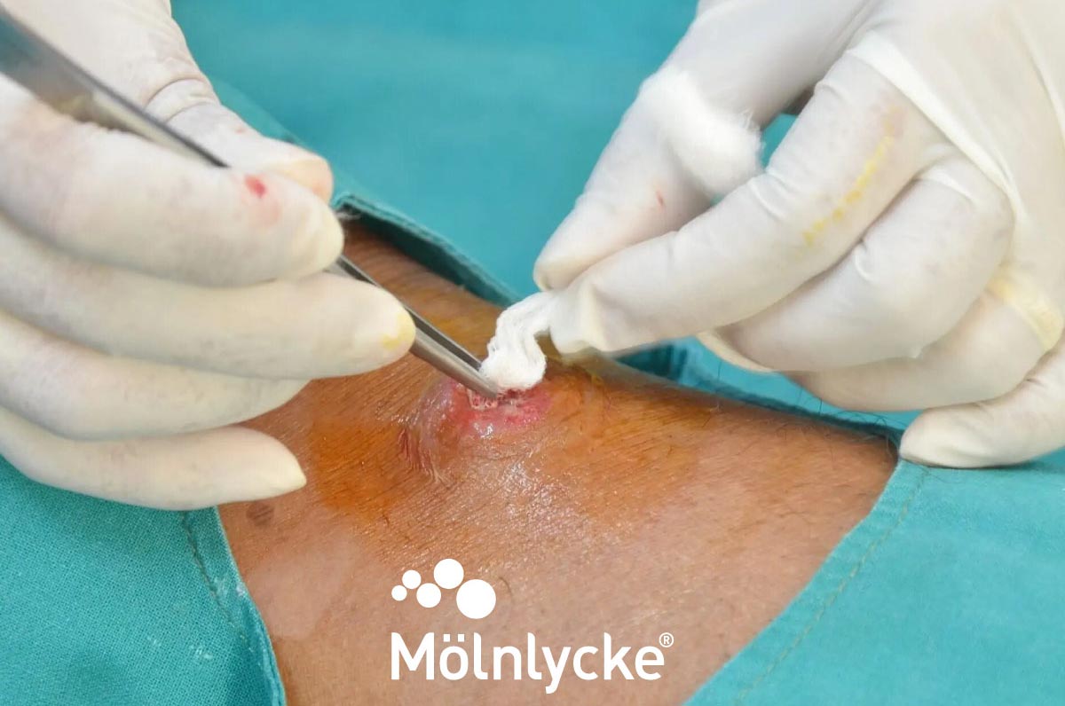 Signos de infección en heridas que indican que se puede usar Mepilex® Ag
